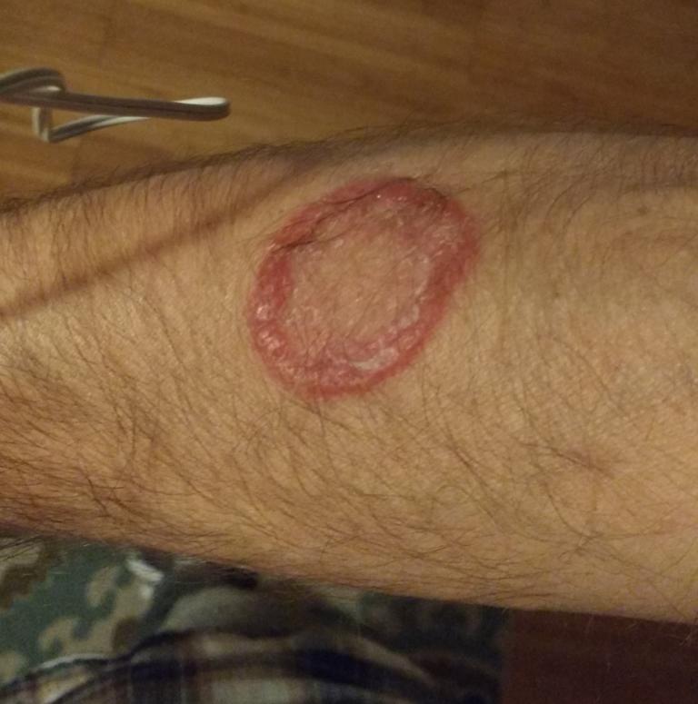 bjj-ringworm